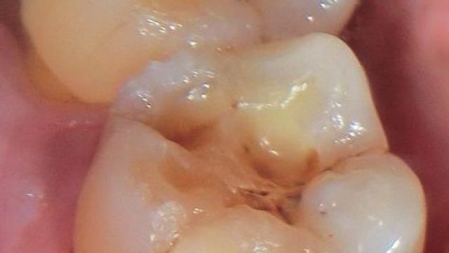 歯が溶ける意外な原因知っていますか？